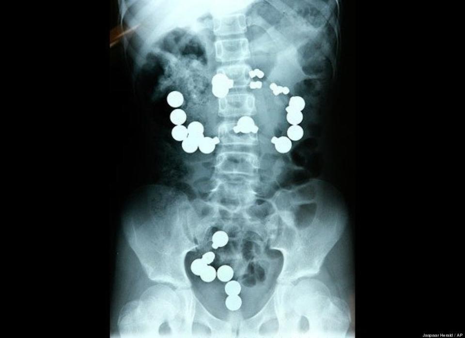 An 8-year-old girl from Indiana swallowed steel balls and magnets from a toy set in May. The child required emergency surgery and was hospitalized for two weeks. 