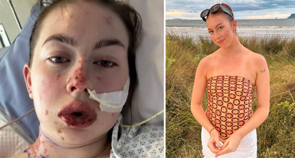 Rare Disorder Causes Severe Reaction: Woman’s Skin, Mouth, and Oesophagus Blister