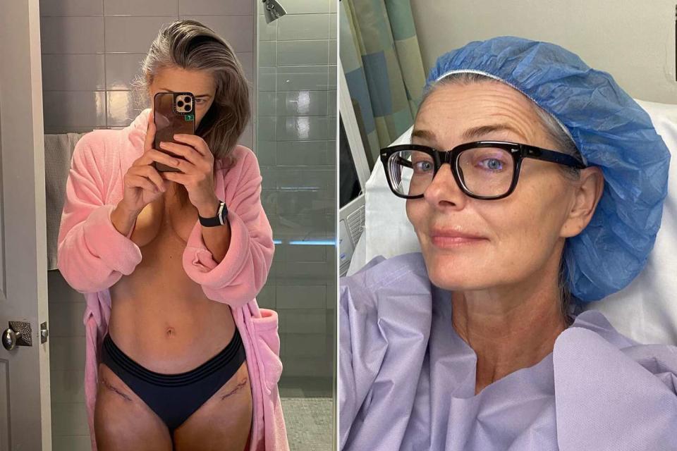 <p>Paulina Porizkova/Instagram</p> Paulina Porizkova showing off her scars after her hip replacement