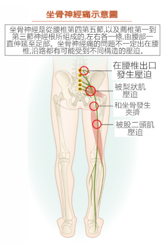 坐骨神經痛示意圖