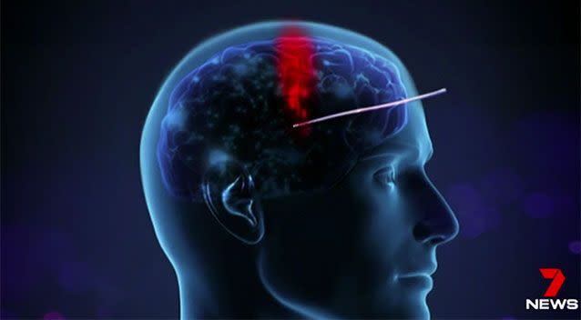 The wire can send beams in different directions to target areas of the brain. Source: 7 News