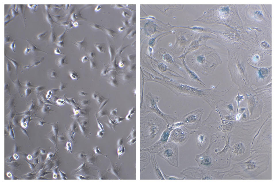 This combination of microscope photos provided by the Mayo Clinic in August 2022 shows healthy myoblast cells, left, and senescent ones. Senescent cells resist apoptosis, or programmed cell death, and characteristically get big and flat, with enlarged nuclei. They release a blend of molecules, some of which can trigger inflammation and harm other cells — and paradoxically also stimulate the growth of malignant cells and fuel cancer, says Mayo Clinic researcher Nathan LeBrasseur. (Dr. Xu Zhang/Mayo Clinic via AP)