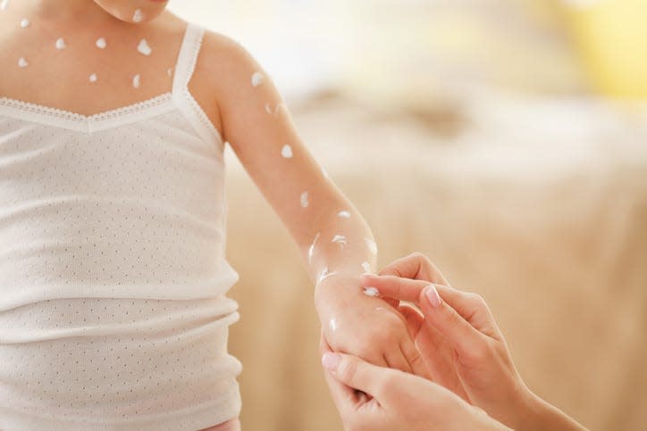 Female hand applying cream on little girl with chicken pox at home