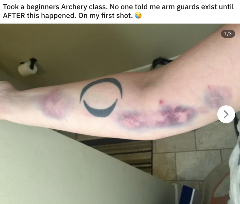 a person's arm covered in bruises