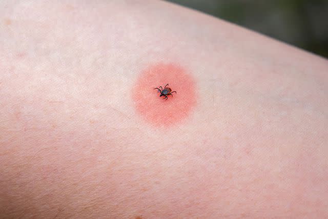 <p>Getty Images/iStockphoto</p> Tick rash