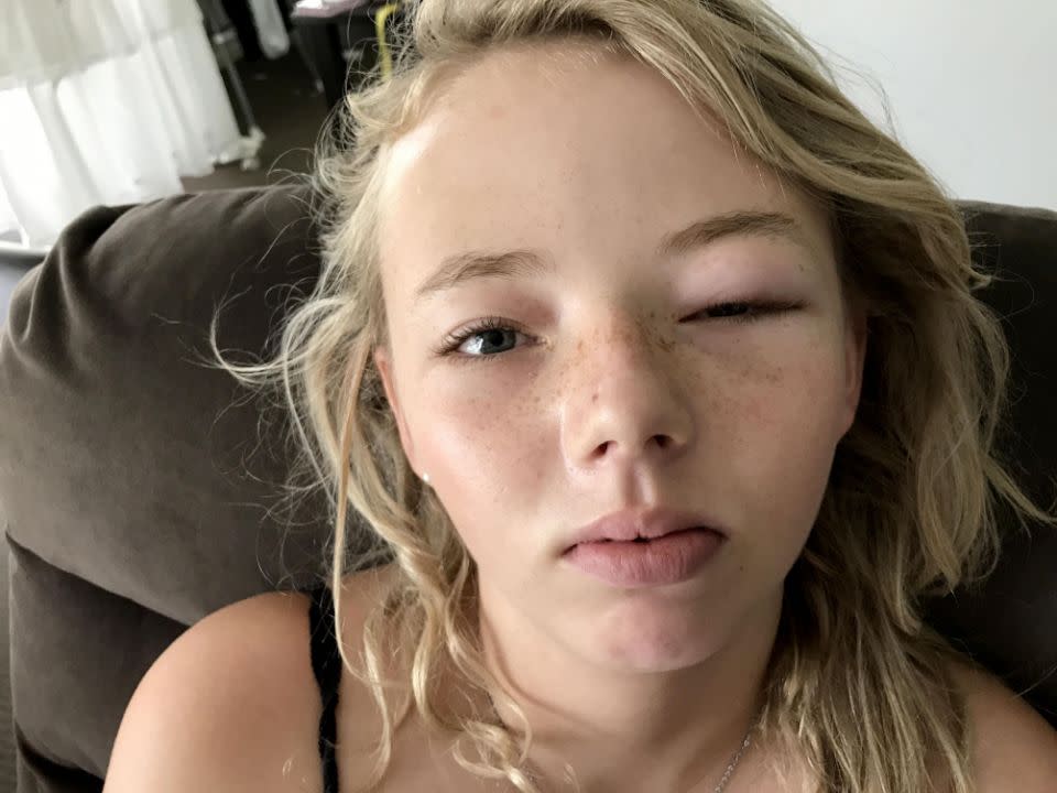 A mum claims her teenage daughter has been left half-blind after a $3 Kmart eye mask allegedly caused a severe allergic reaction. Photo: Caters News