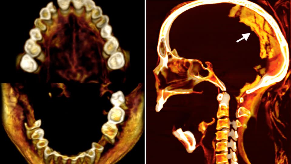 CT-Scans, darunter der Zähne (links) und des Gehirns, enthüllten neue Details über die Morphologie, Gesundheit und Erhaltung der Mumie.  -Sahar Saleem