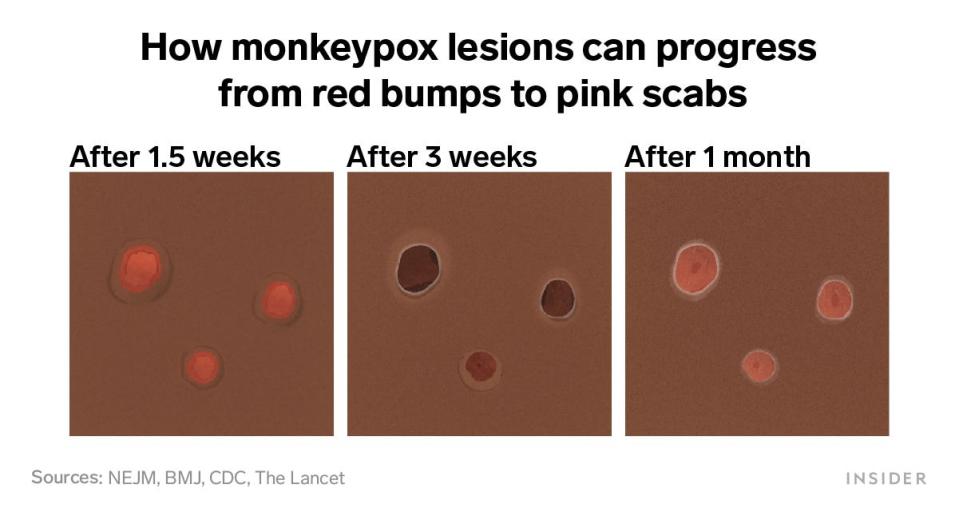 How monkeypox lesions can progress from red bumps to pink scabs.