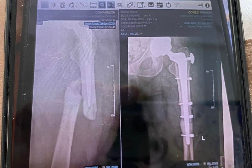 X-ray showing Ms Boot's snapped femur