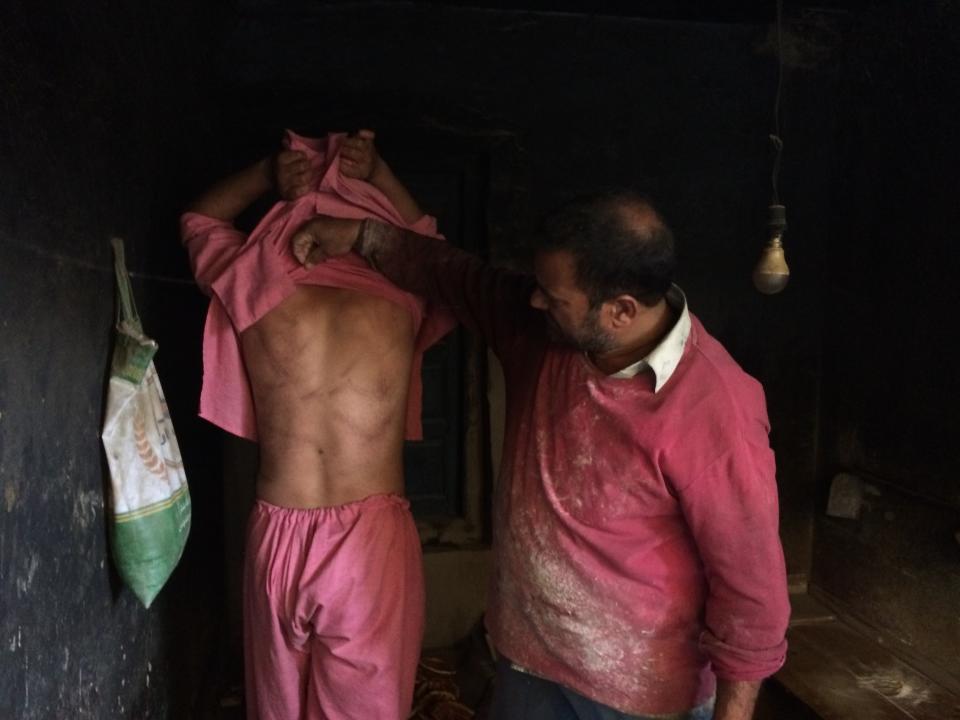 In this Monday, Aug. 26, 2019, photo, a Kashmiri baker Sonaullah Sofi lifts the shirt from his son's back to show torture marks allegedly caused by Indian army soldiers at their bakery in southern village of Parigam, Indian controlled Kashmir. The main city of Indian-controlled Kashmir presents a mostly deserted and subdued look, woven in a maze of razor wire. But drive out into the rural hinterland and residents in village after village narrate horrors of regular nightly raids by Indian army soldiers. Sofi's family was asleep when army troops raided his home. The soldiers took his two sons into a street, hitting them with gun butts, iron chains and sticks, Sofi said. “Helpless, I heard my sons scream as soldiers started beating them up mercilessly in the middle of the road,” Sofi said. ( AP Photo/Aijaz Hussain)