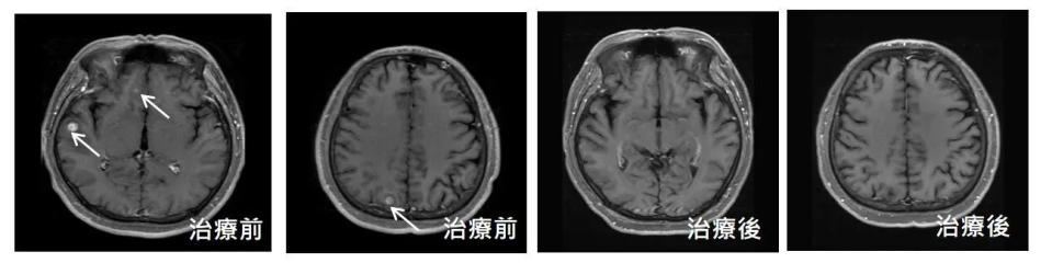 <strong>長期吸菸37歲男子的核磁共振影像。（圖／奇美醫院提供）</strong>