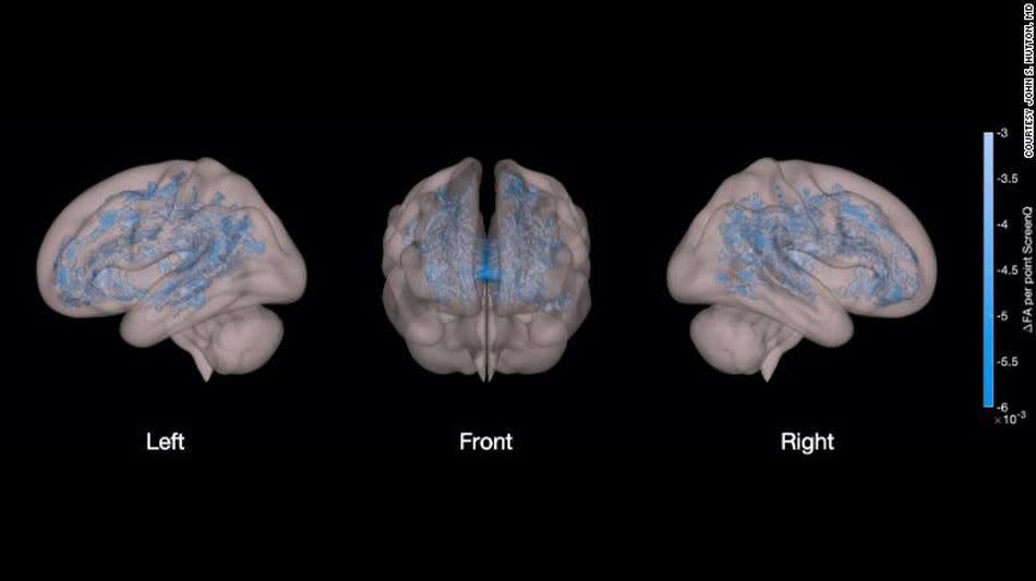 Un estudio documenta la posible relación entre el uso de pantallas y un menor desarrollo de materia blanca en niños en edad preescolar. | imagen Hutton et al. 