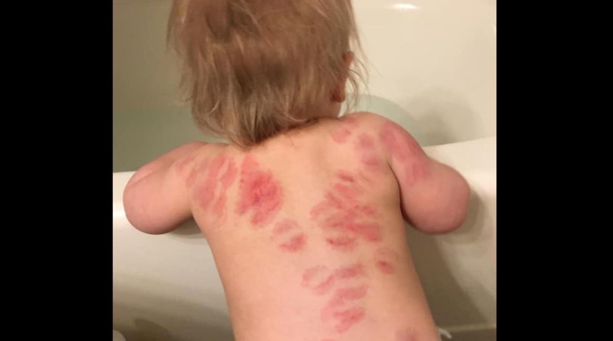 An Arizona mom shared shocking photographs of over 25 bite marks her 15-month-old daughter allegedly sustained at daycare. (Photo: Facebook)