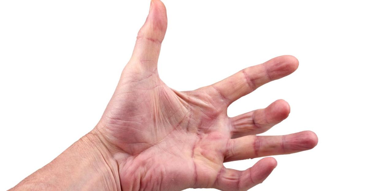 hand of an man with dupuytren contracture disease