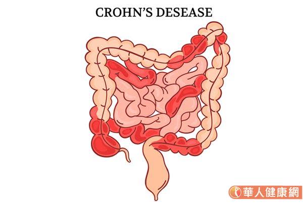 寄生蟲是敵是友？人體野化實驗：科學家復育腸道寄生蟲，竟發現這意外結果