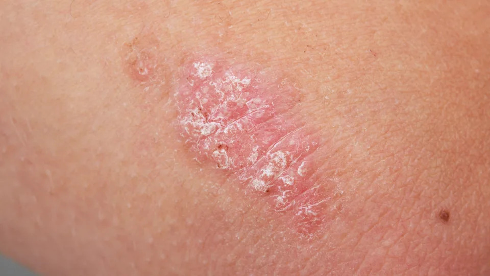 Psoriasis plaque or skin rash