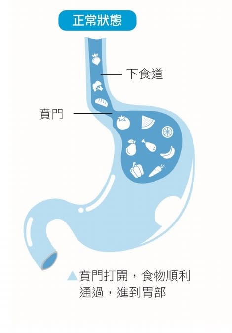 壓力大：腹部加壓，食物被推回食道