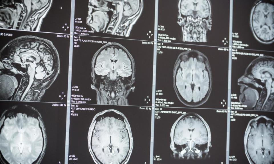 MRI scan of a brain