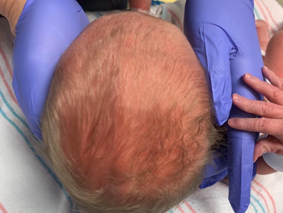 Physician's assistant Emilie Martinez prepares a baby's skull for a new method of treatment