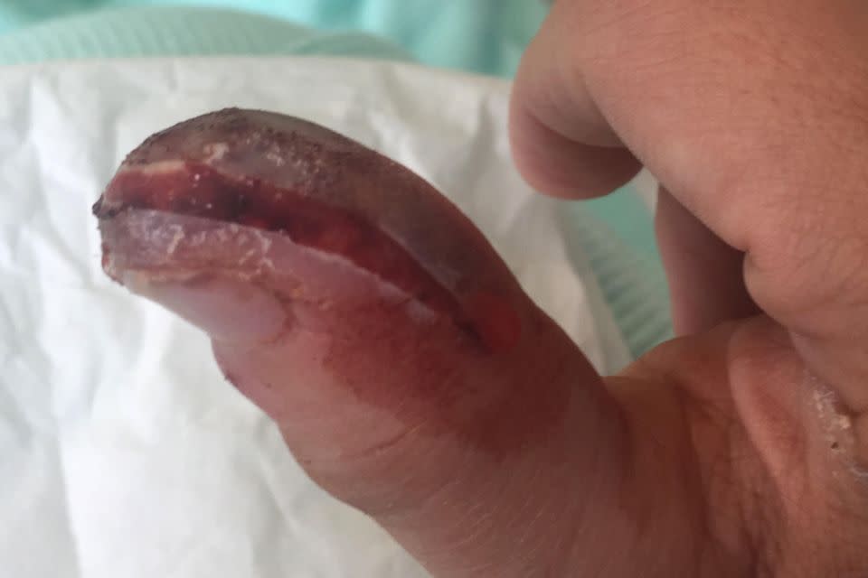 She was rushed to hospital when her thumb turned purple. Photo: Caters