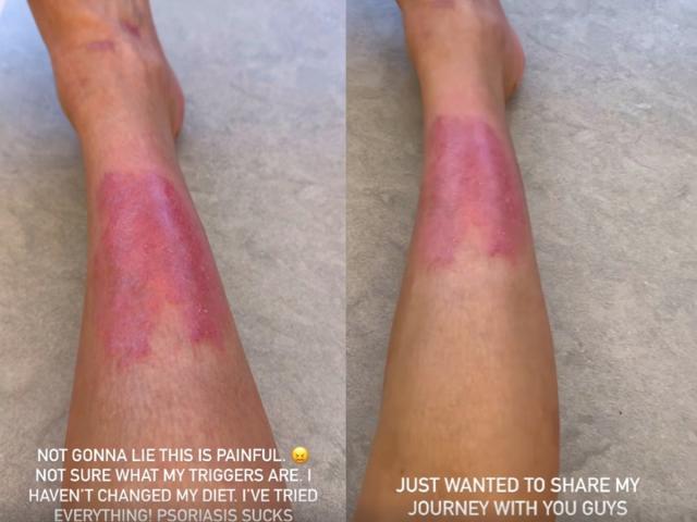Kim Kardashian Shared Videos of Her 'Painful' Psoriasis Flare-Up on  Instagram