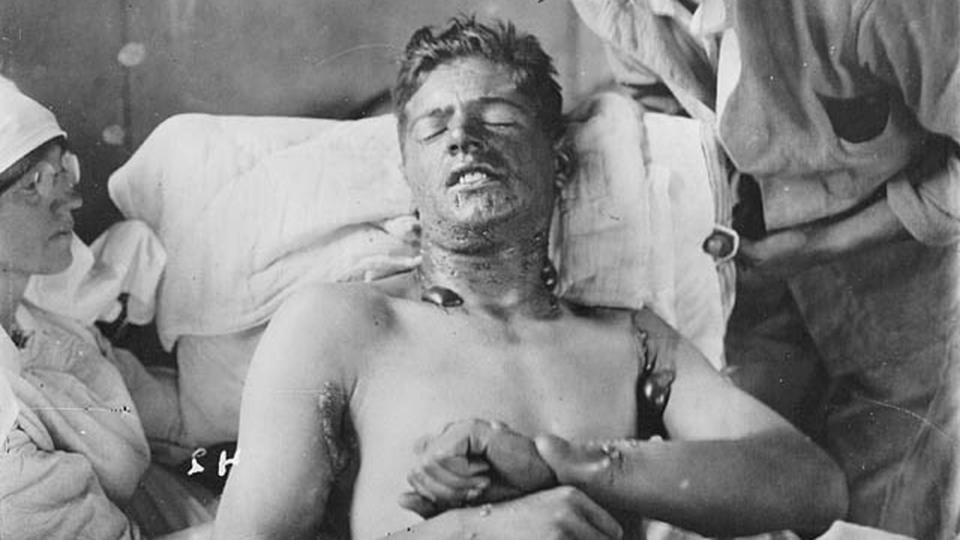 World war One, Canadian soldier in a field hospital, with mustard gas burns, 1915. (Photo by Universal History Archive/Universal Images Group via Getty Images)