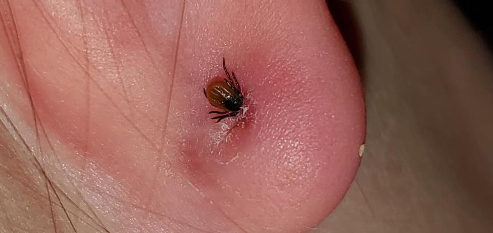 The tick embedded itself into the back of the child's earring backing. Source: Facebook