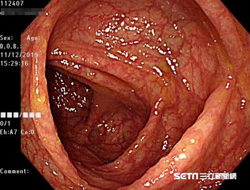 護理師建議國人最晚30歲過後應接受大腸鏡檢查。