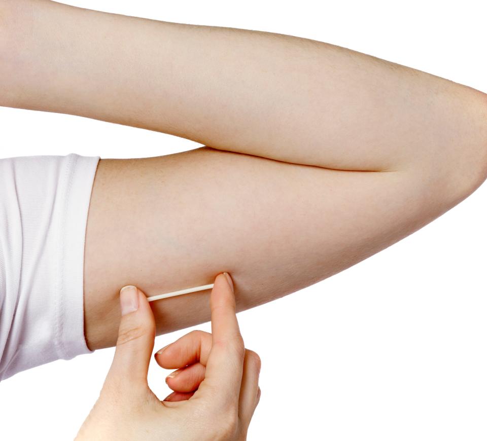 Nexplanon, also known as the hormonal arm implant.