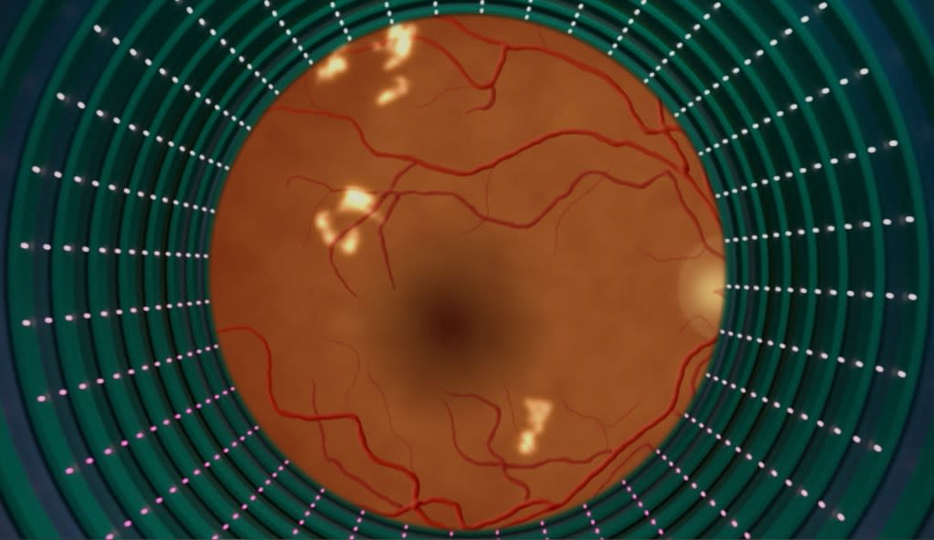 A rendering of a retina provided by Digital Diagnostics, one of three companies with FDA-approved AI eye exams. Its system captures images of a patient's retina and uses an algorithm to identify diabetic retinopathy. (Digital Diagnostics)