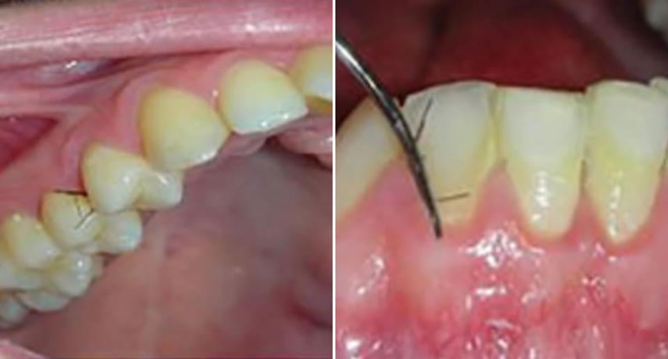 Inside a woman's mouth where small eye-lash like hairs can be seen growing between her gums.