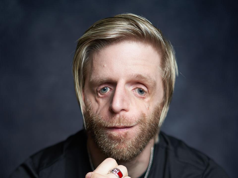 Jonathan Lancaster, who has Treacher Collins syndrome, causing a facial difference, strikes a meditative pose.