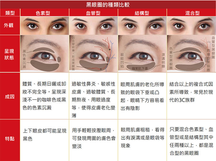 ▲判斷黑眼圈類型，可幫助治療更加精準。（圖/粹究美學診所提供）