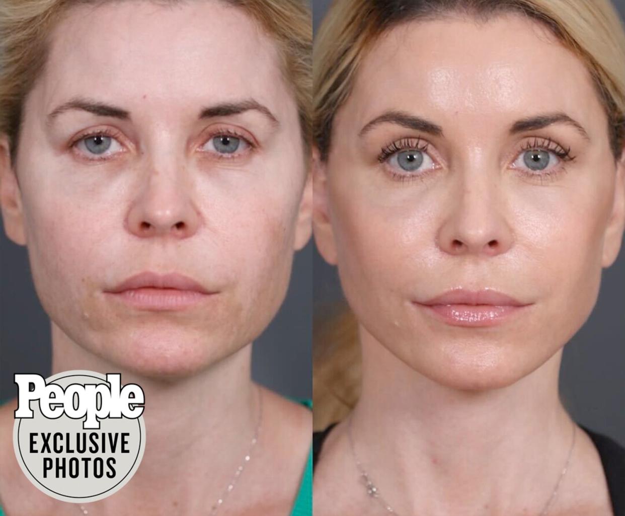 McKenzie Westmore Shares Transformation Photos After Her Face Lift with Dr. Nassif