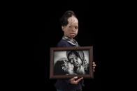 <p>A victim of an acid attack in Iran holds a picture of fellow victims. (Asghar Khamseh/SWPA) </p>