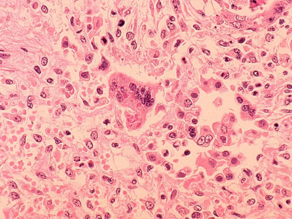 Tissue from a patient suffering with measles-associated pneumonia (Getty Images)