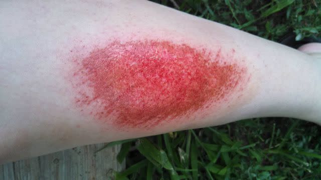 Second Degree Burn Pictures