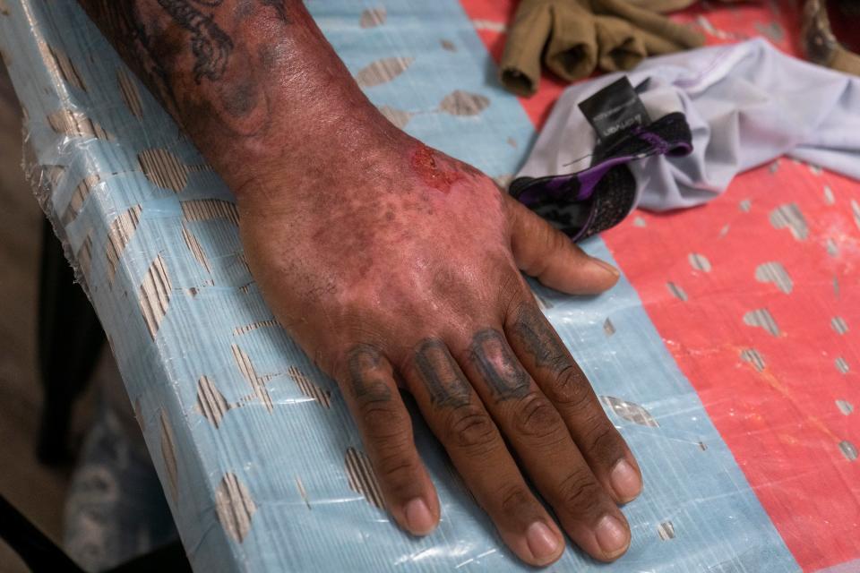 Kahlil "Bubba" Floyd shows how his arm and hand looks now during an interview at one of The Tattooed Pig locations, which he runs with his wife, Angie Floyd, in Aston on Monday, Oct. 9, 2023.

Floyd had been burned on September 2, 2023 when a car struck the food truck he was working in in Wimington's Trolly Square area.

[Daniella Heminghaus]