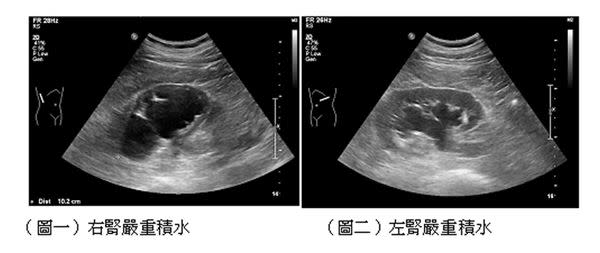 斷層掃描和超音波掃瞄發現，該患者雙側腎臟嚴重積水。（圖片／陳正哲醫師提供）