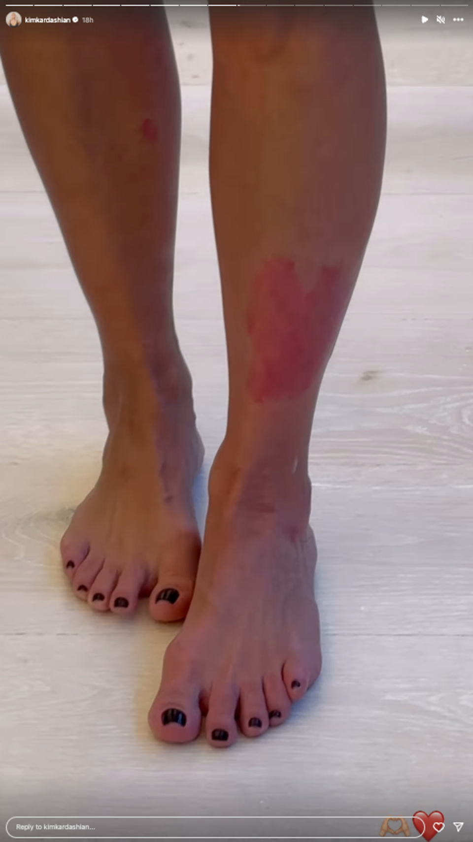 Kim Kardashian jokes psoriasis flareup resembles the shape of a heart (Kim Kardashian/Instagram)