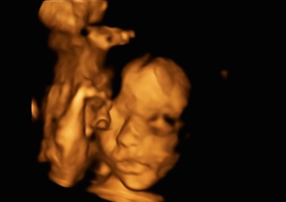 A scan at 20 weeks showed the baby’s head wasn’t the right measurement (Picture: Bethan Simpson/Facebook)