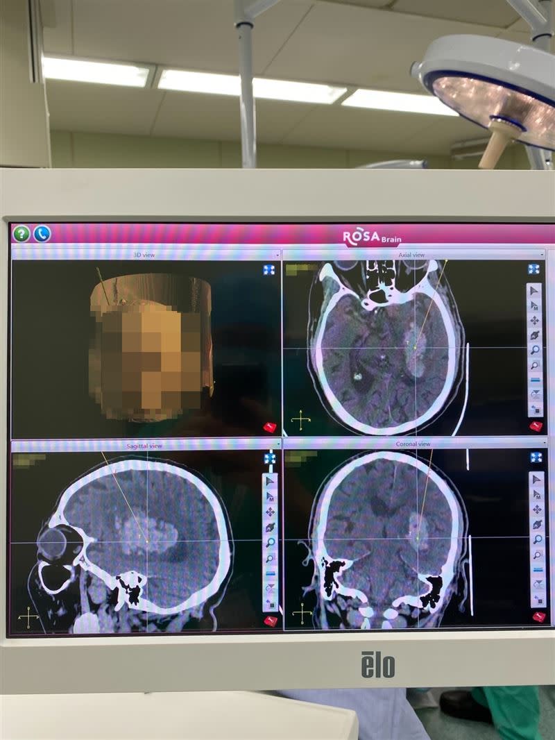 出血性腦中風常見發生原因為病人血壓控制不當，由電腦斷層可發現血塊（白色處）壓迫到腦部細胞。（圖／雙和醫院提供）