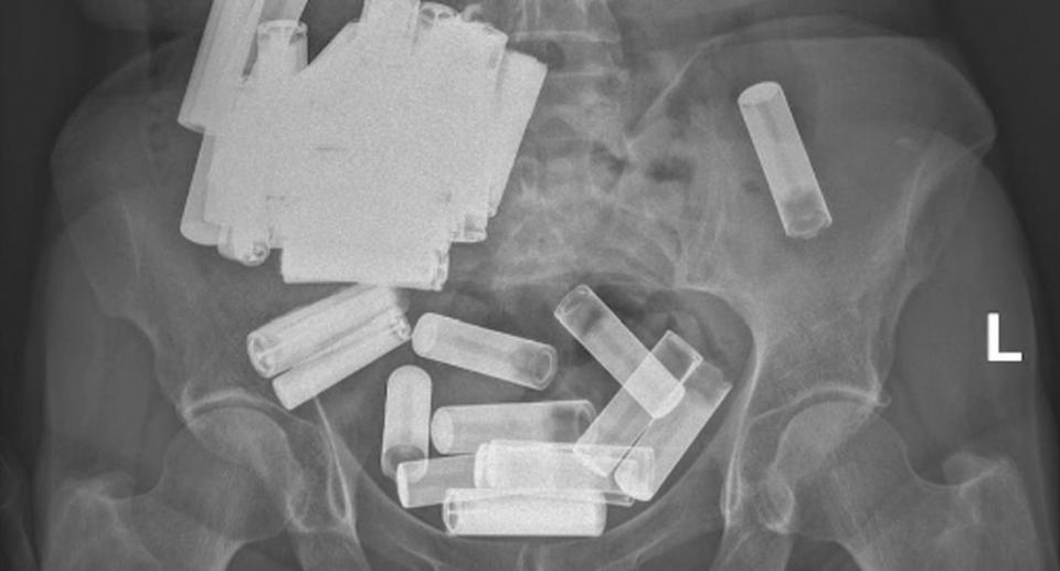 An x-ray of several batteries in a 66-year-old woman's stomach and colon. Source: Journal of the Irish Medical Organisation. 