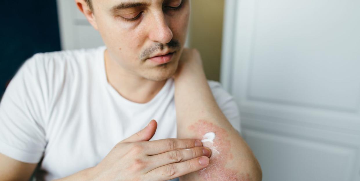 man who uses ointments, creams in the treatment of eczema, psoriasis and other skin diseases