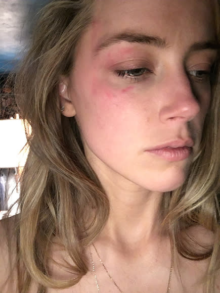 Amber Heard Seen with Black Eye Leaving L.A. Courthouse After Domestic Violence Claim Against Johnny Depp| Movie News, Amber Heard, Johnny Depp