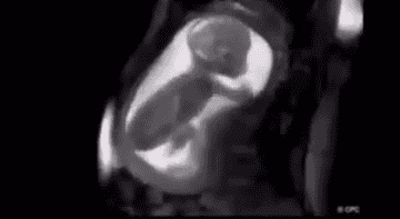 MRI scan showing a fetus in the uterus