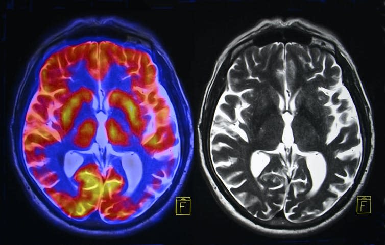 Image of an MRI brain scan.