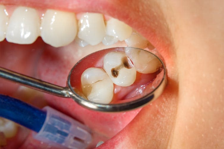 <span class="caption">Cavities emerge when tooth decay is untreated, and they often require a filling.</span> <span class="attribution"><a class="link " href="https://www.shutterstock.com/image-photo/dental-caries-filling-composite-photopolymer-material-1049813315?src=RgkxwGlJtXdQCOswROCSKA-1-0" rel="nofollow noopener" target="_blank" data-ylk="slk:Sergii Kuchugurnyi/Shutterstock;elm:context_link;itc:0;sec:content-canvas">Sergii Kuchugurnyi/Shutterstock</a></span>