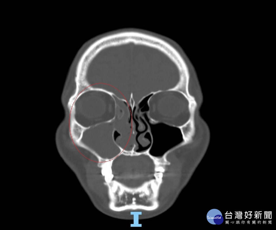 鼻塞呼吸不順難入睡　 檢查取出10公分乳突瘤