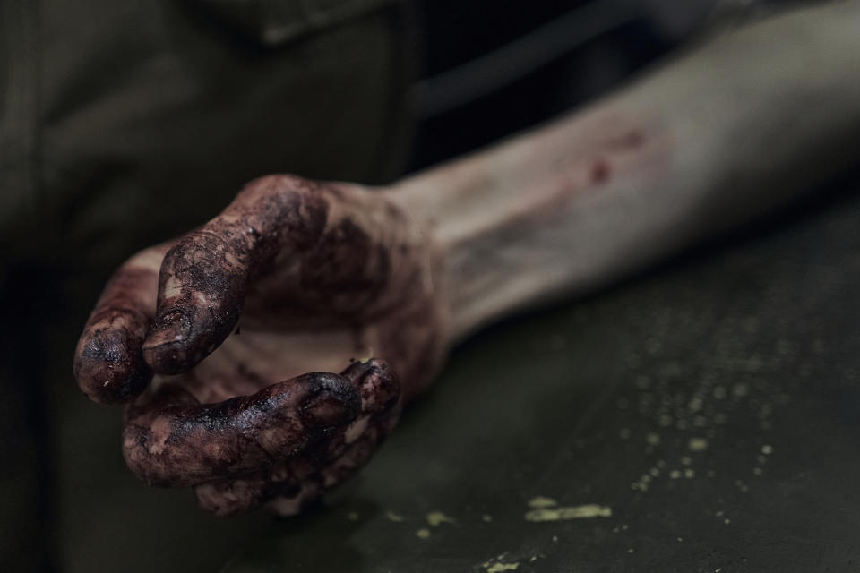 The blood covered hand of a Ukrainian wounded soldier who gets the first aid is seen at a medical stabilisation point near Bakhmut, Donetsk region, Ukraine, Monday, June 19, 2023. (AP Photo/Libkos)
